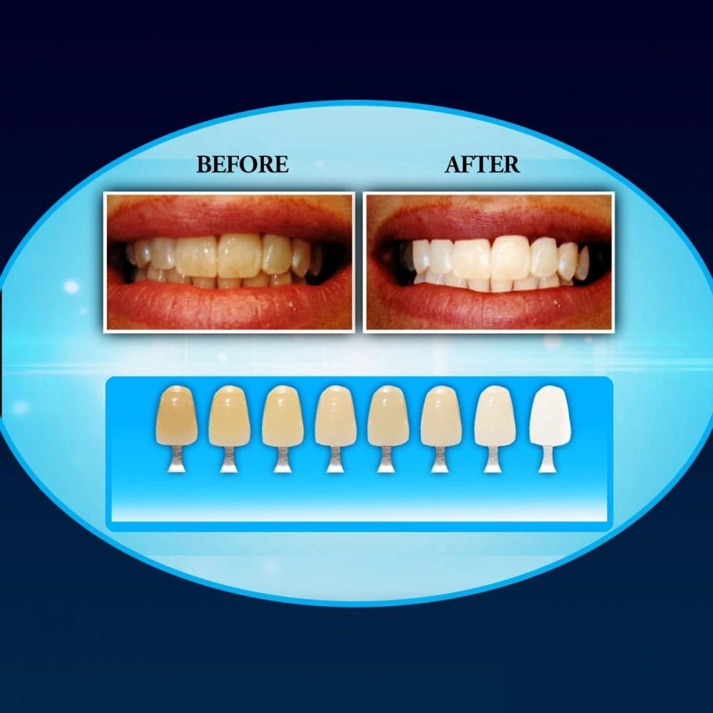 Отбеливание зубов сколько стоит в ульяновске цена можно ли заливать в ирригатор хлоргексидин