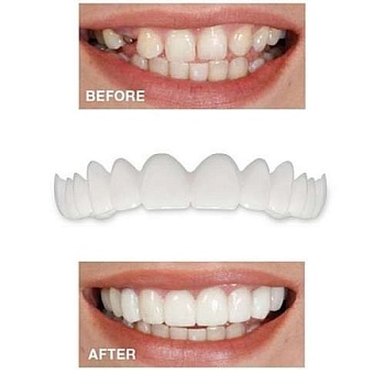 Виниры для зубов Snapon Smile